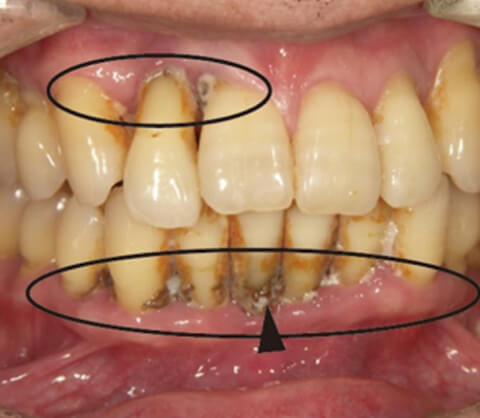 severe periodontal health