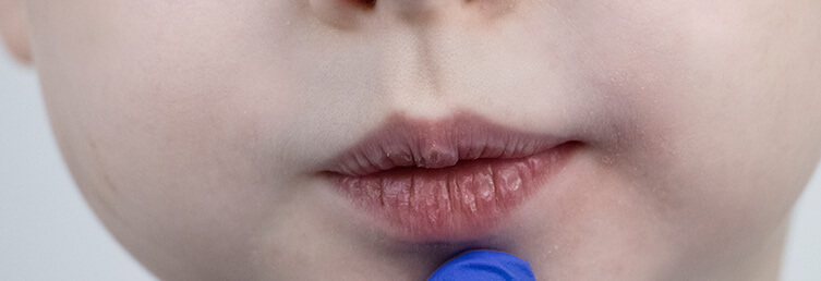 closeup of a child's chapped lips
