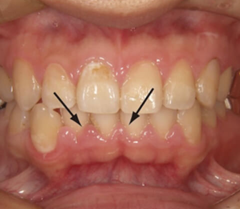 moderate periodontal health