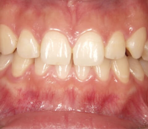 normal periodontal health